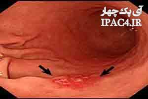 symptoms-diagnosis-and-prevention-of-gastric-cancer