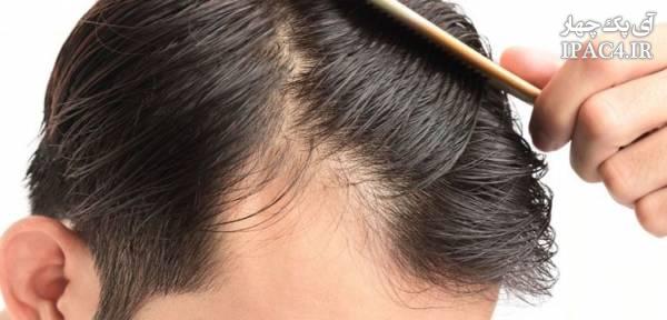 ریزش مو در مردان به چه دلیل اتفاق می افتد؟